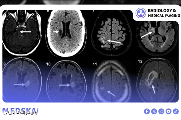 MRI Brain Protocol for Stroke Fast Technologist Workflow_Artboard 2 copy 9